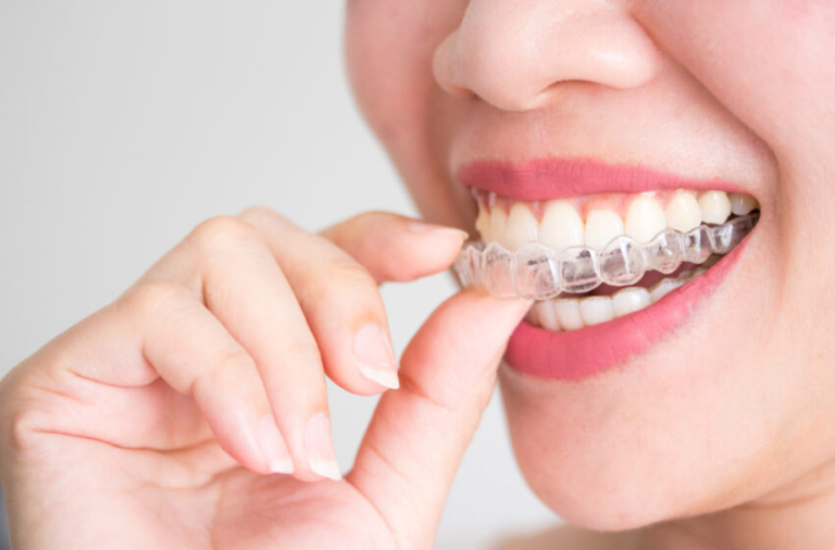 Things You Should Know Before Getting Invisalign